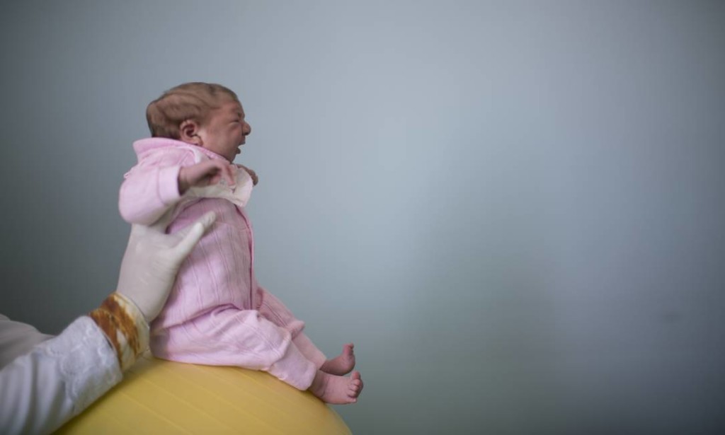 bebe-microcefalia-zika