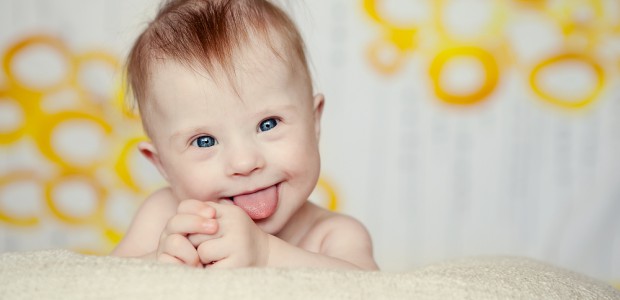 criança-com-trissomia-21