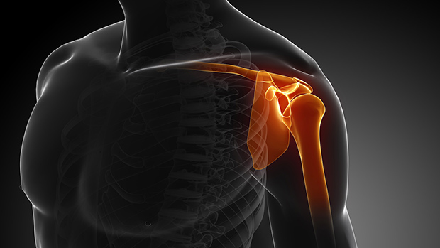 Como prevenir as lesões no crossfit-lesão no ombro