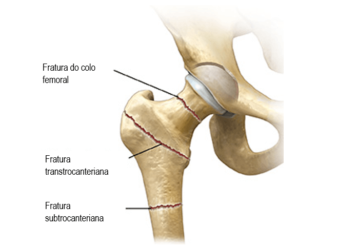 Fratura-do-fêmur-proximal-fratura-do-colo-femoral-fratura-transtrocanteriana-fratura-subtrocanteriana-fratura-do-quadril
